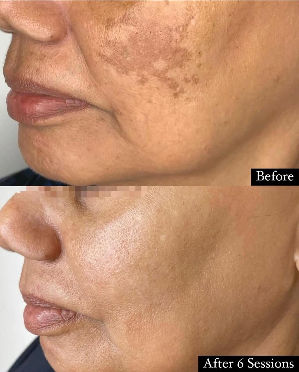 Melasma