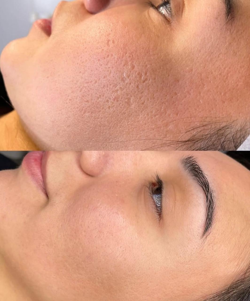 Acne Scars Treatment